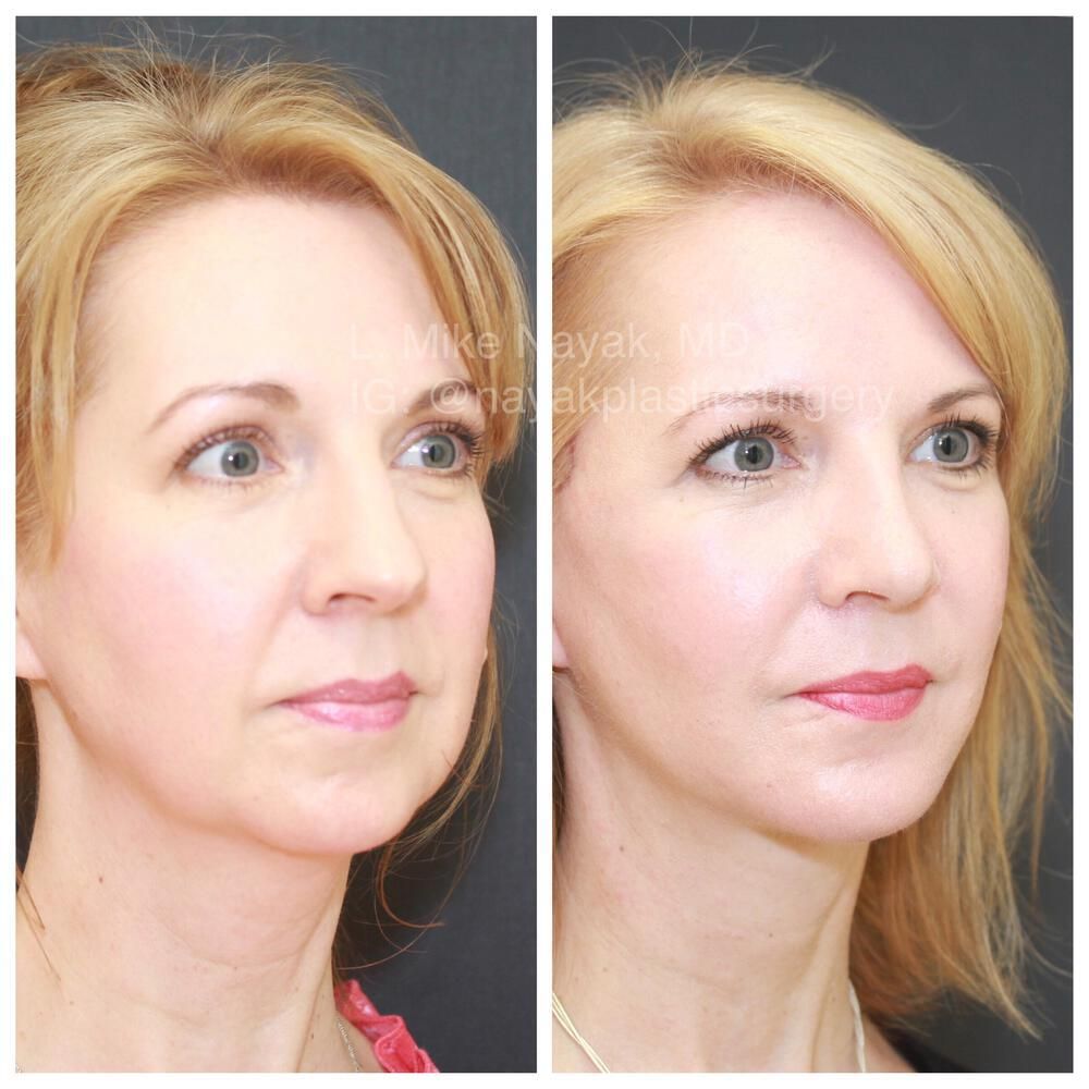 Chin Implant Before & After