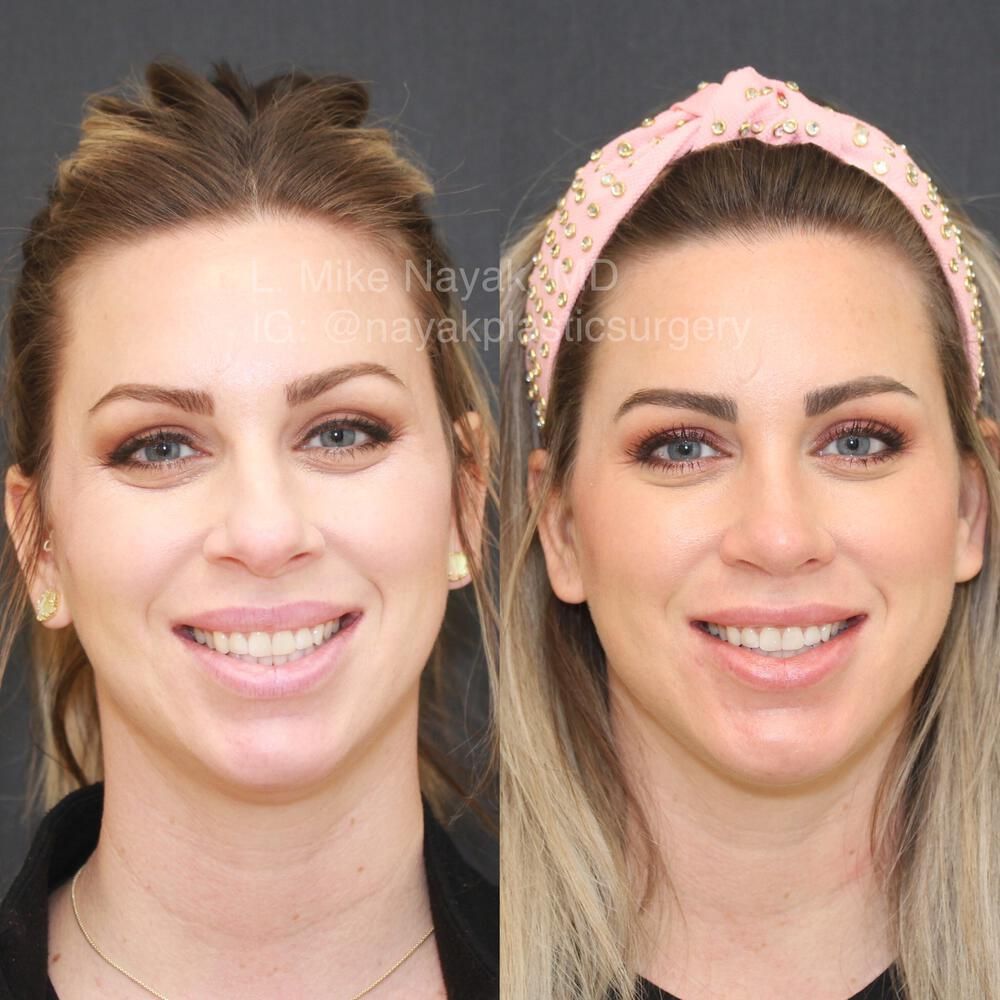 Chin Implant Before & After