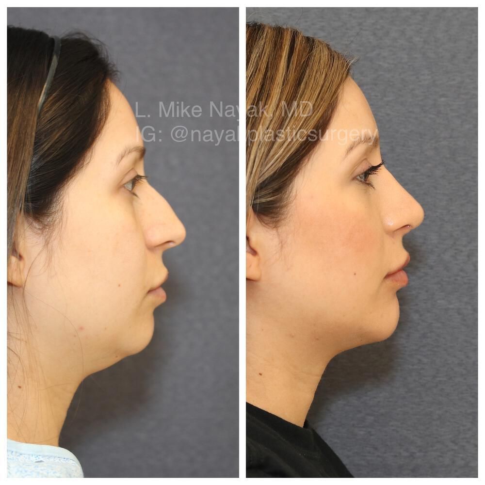 Chin Implant Before & After