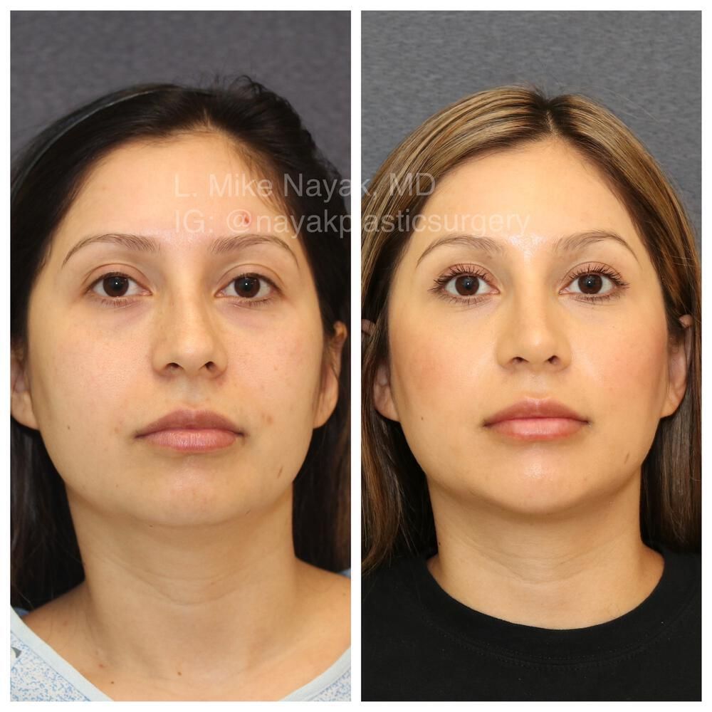 Chin Implant Before & After