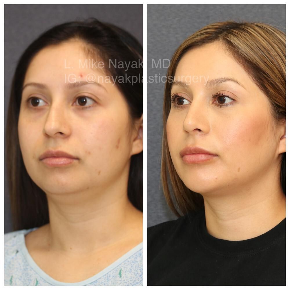 Chin Implant Before & After