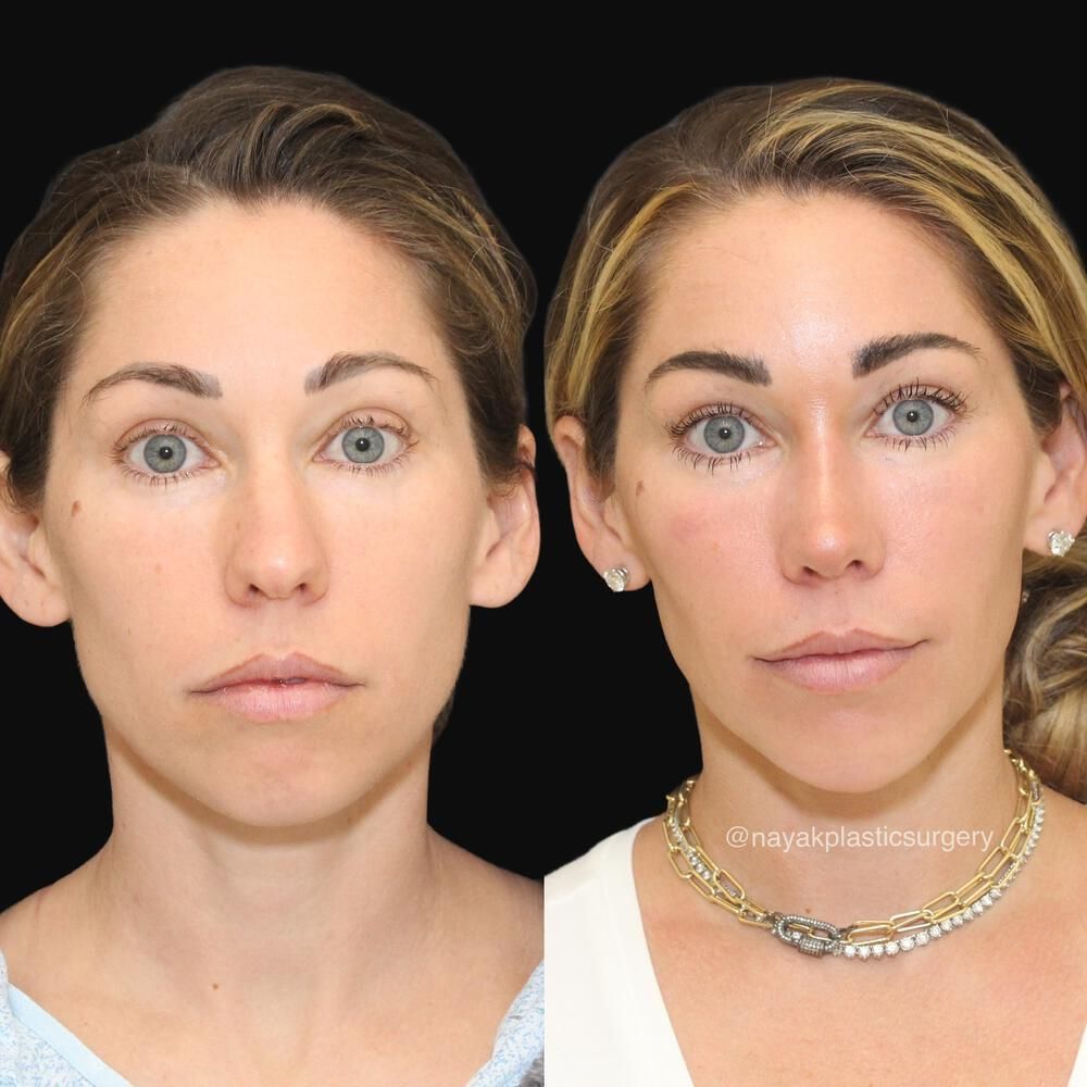 Chin Implant Before & After