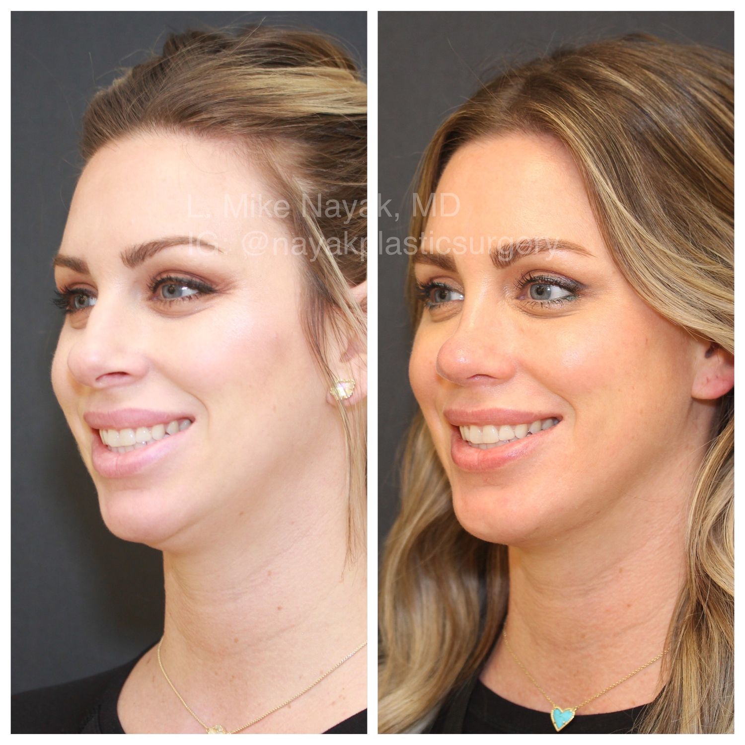Chin Implant Before & After