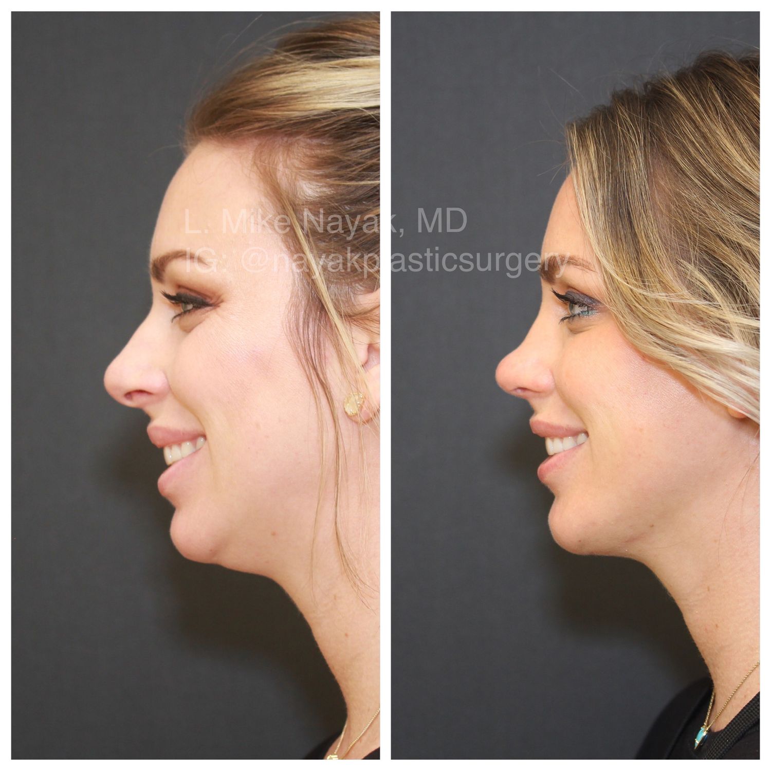 Chin Implant Before & After