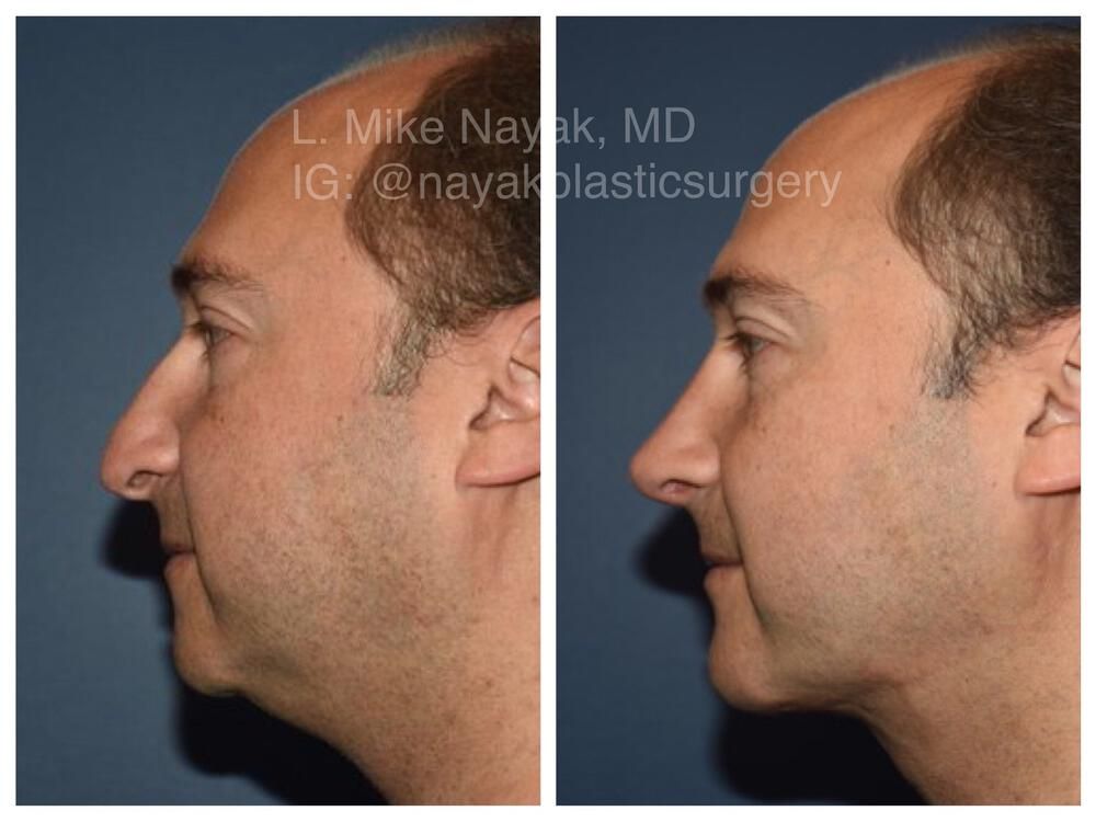 Chin Implant Before & After