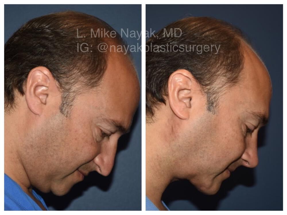 Chin Implant Before & After