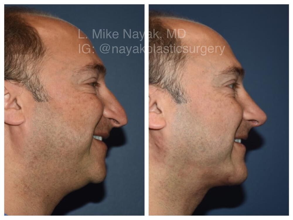 Chin Implant Before & After