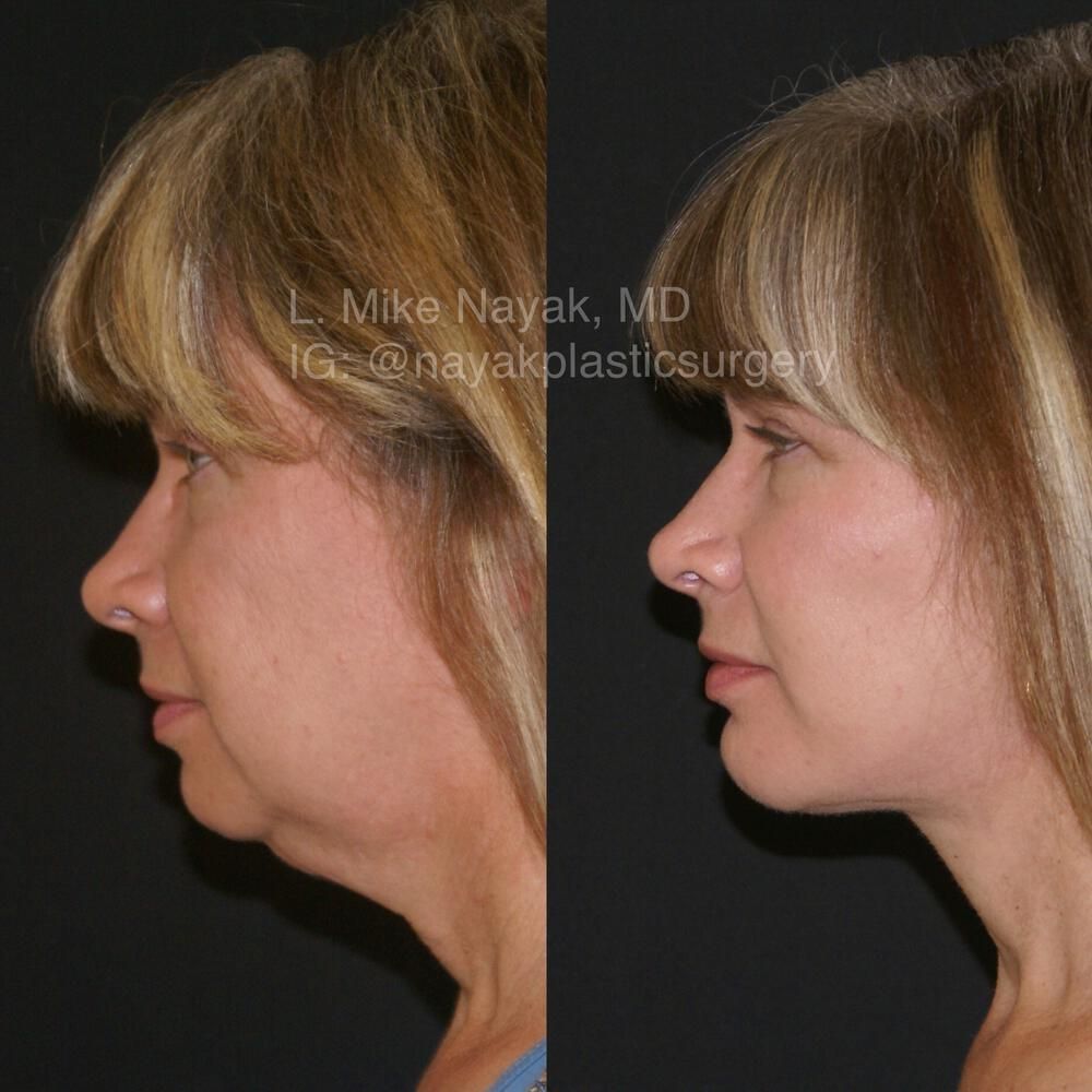 Chin Implant Before & After