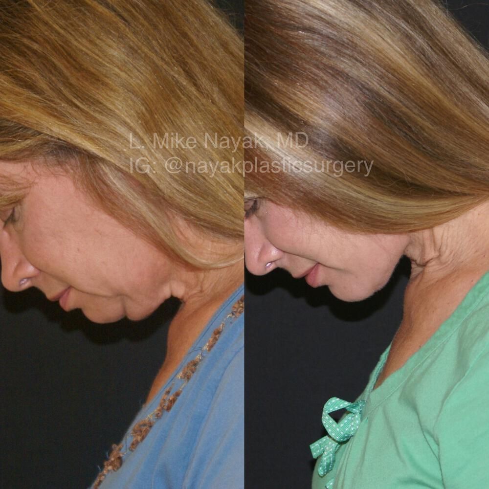 Chin Implant Before & After