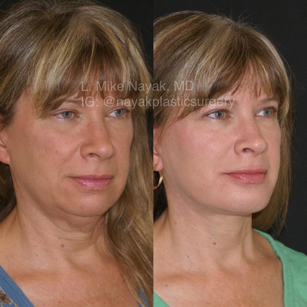 Chin Implant Before & After