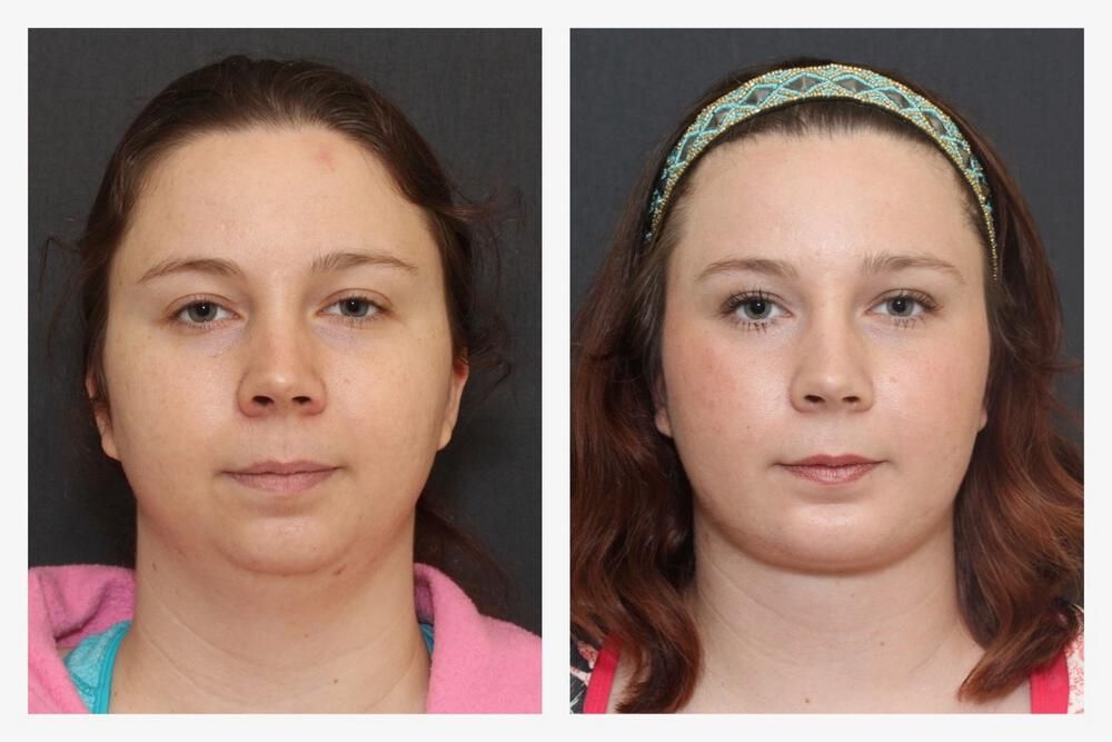 Chin Implant Before & After