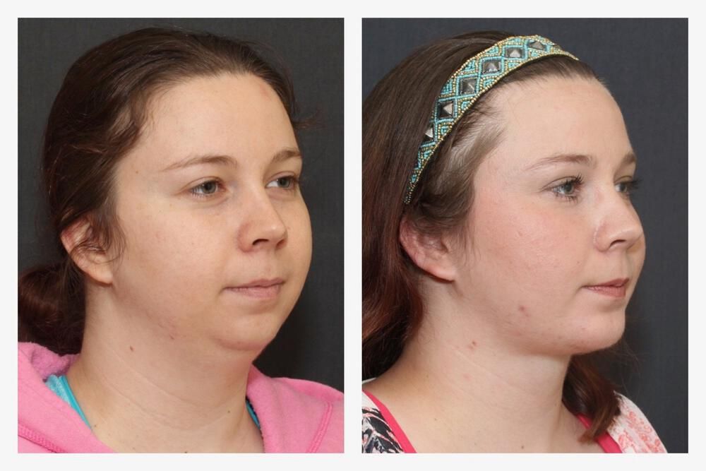 Chin Implant Before & After