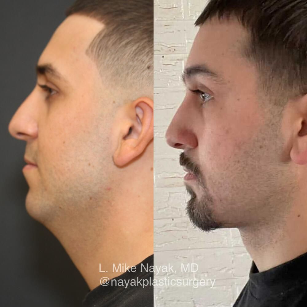 Chin Implant Before & After