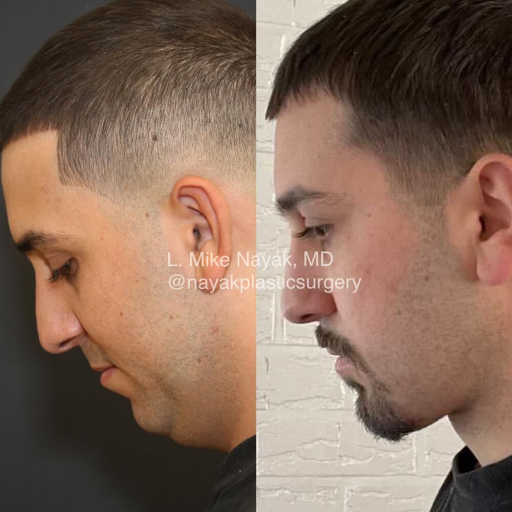 Chin Implant Before & After