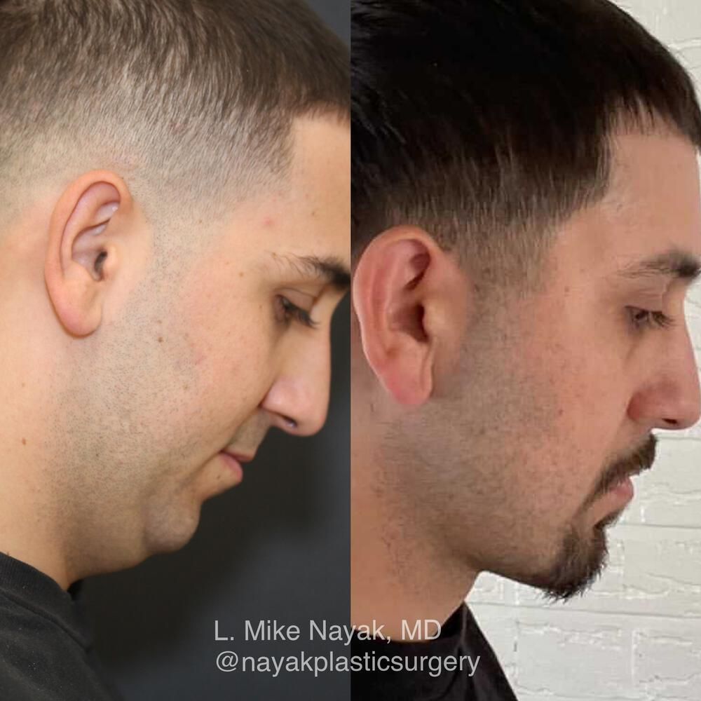 Chin Implant Before & After
