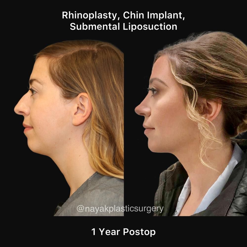 Chin Implant Before & After
