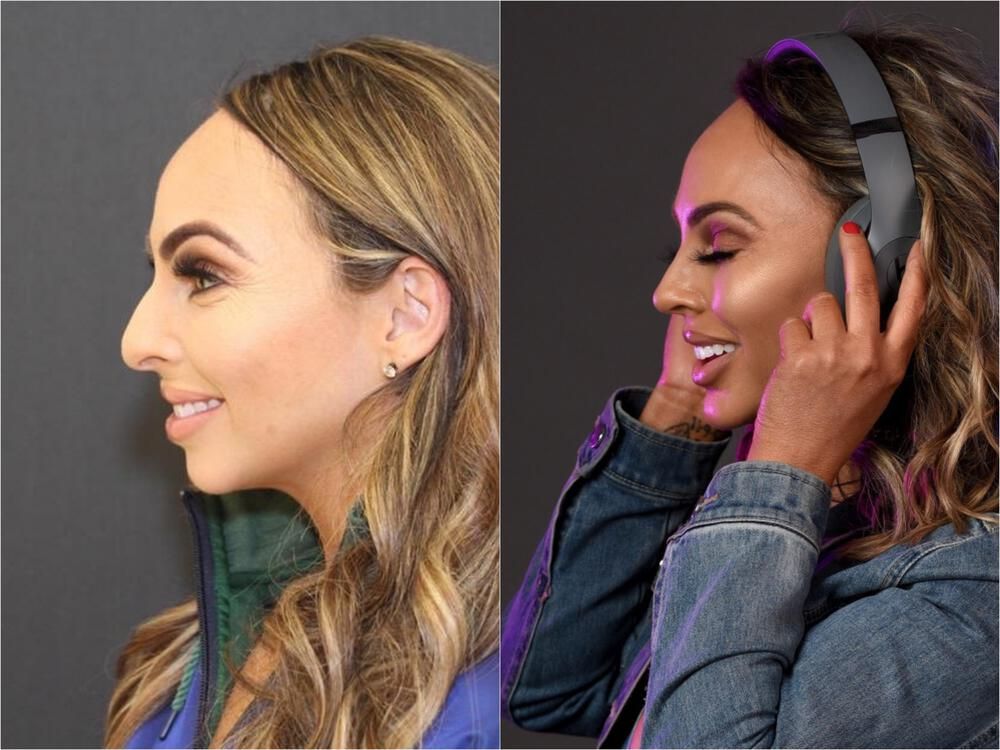 Chin Implant Before & After