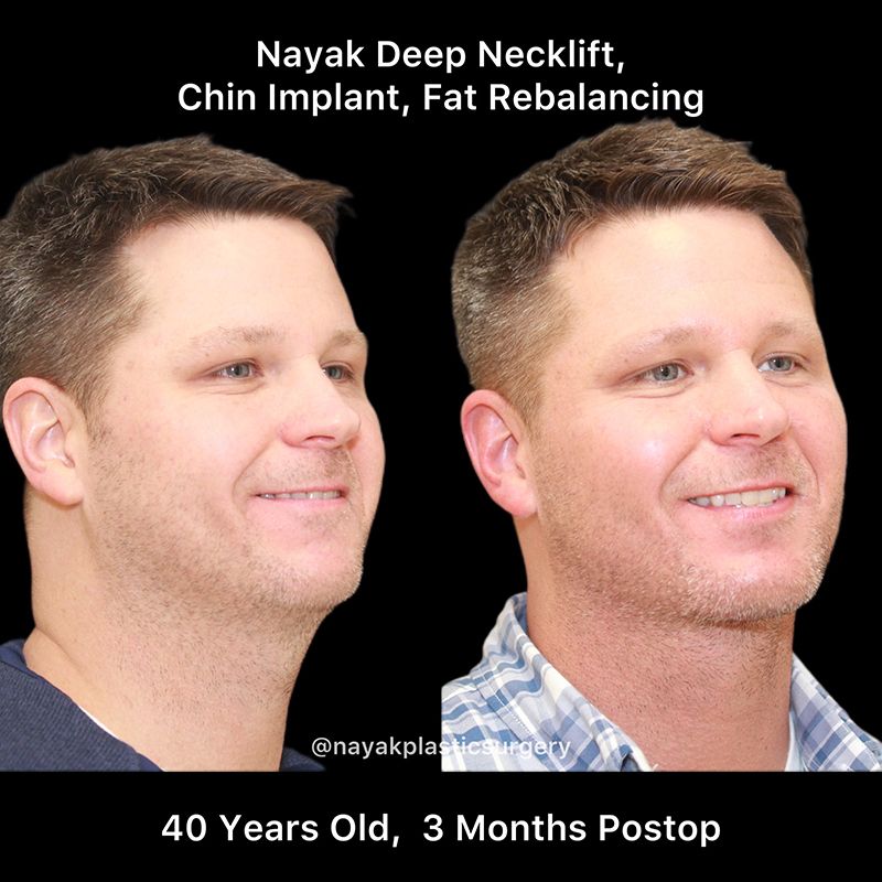 Chin Implant Before & After