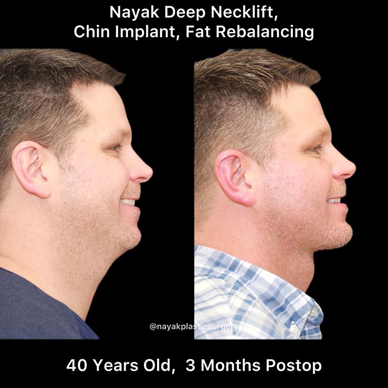 Chin Implant Before & After