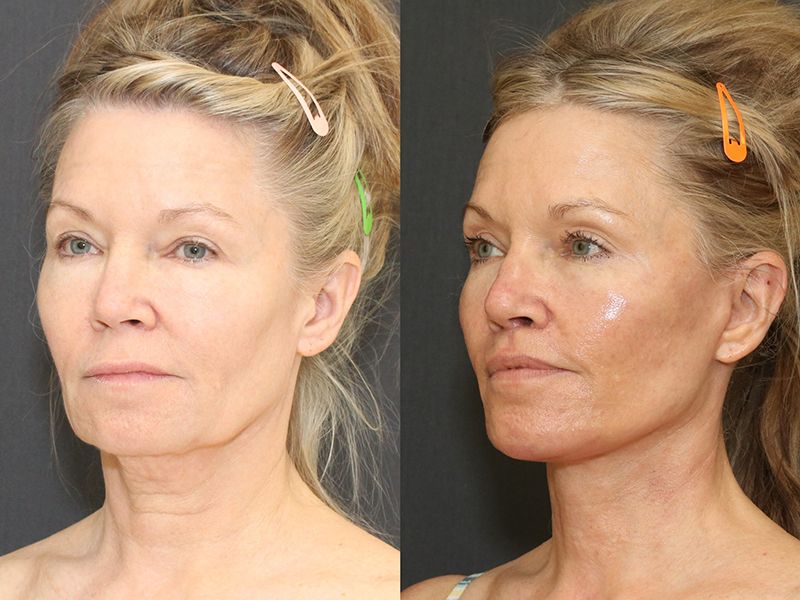 Chin Implant Before & After