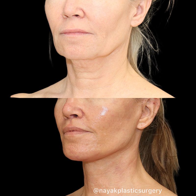 Chin Implant Before & After