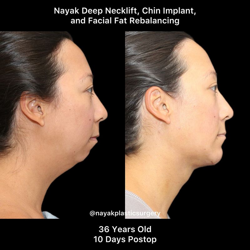 Chin Implant Before & After