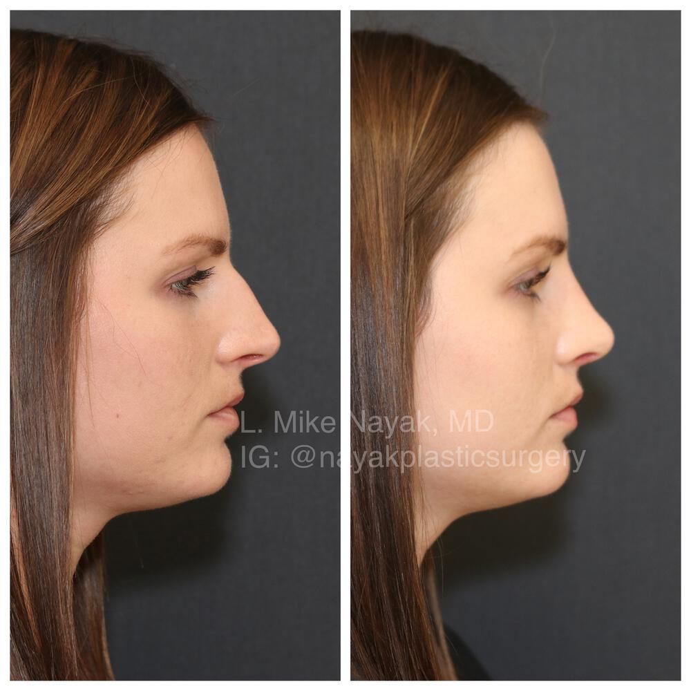 Rhinoplasty Before & After