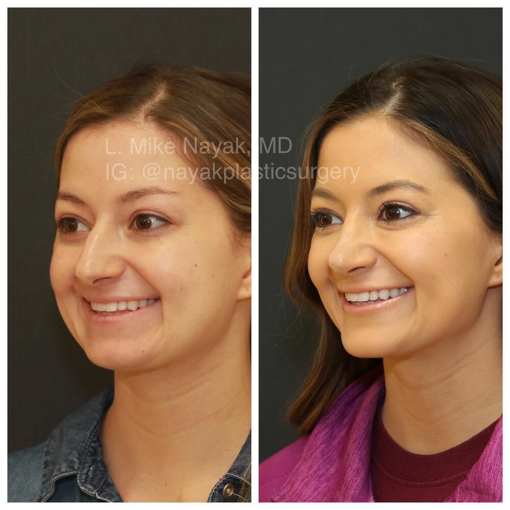 Rhinoplasty Before & After