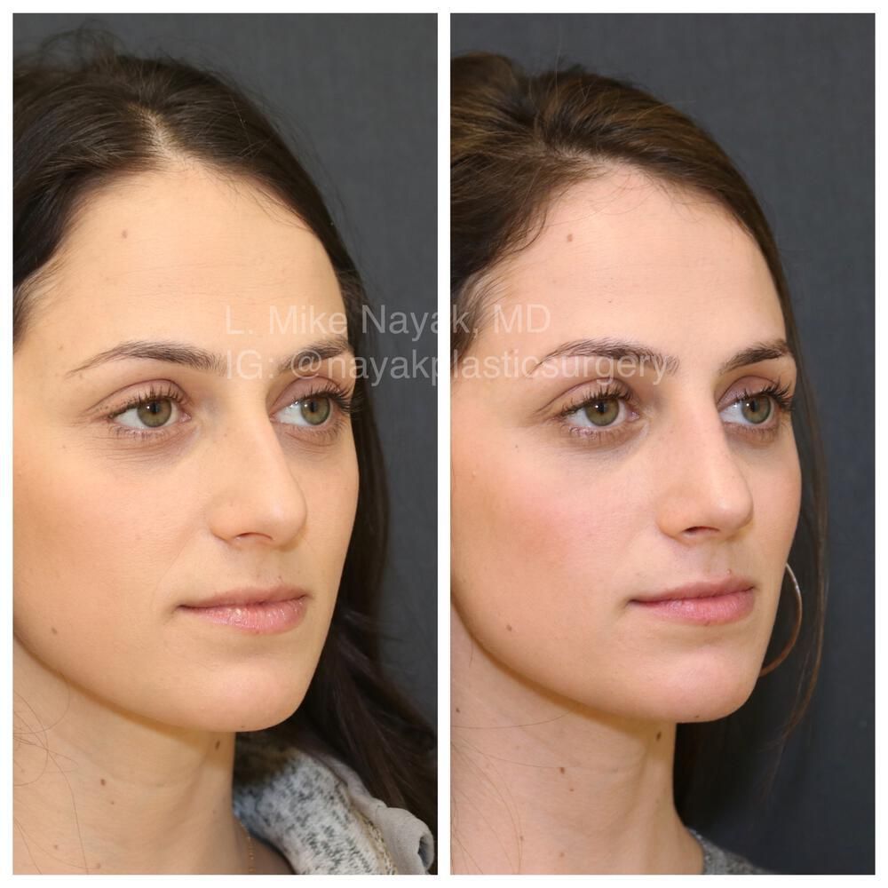Rhinoplasty Before & After