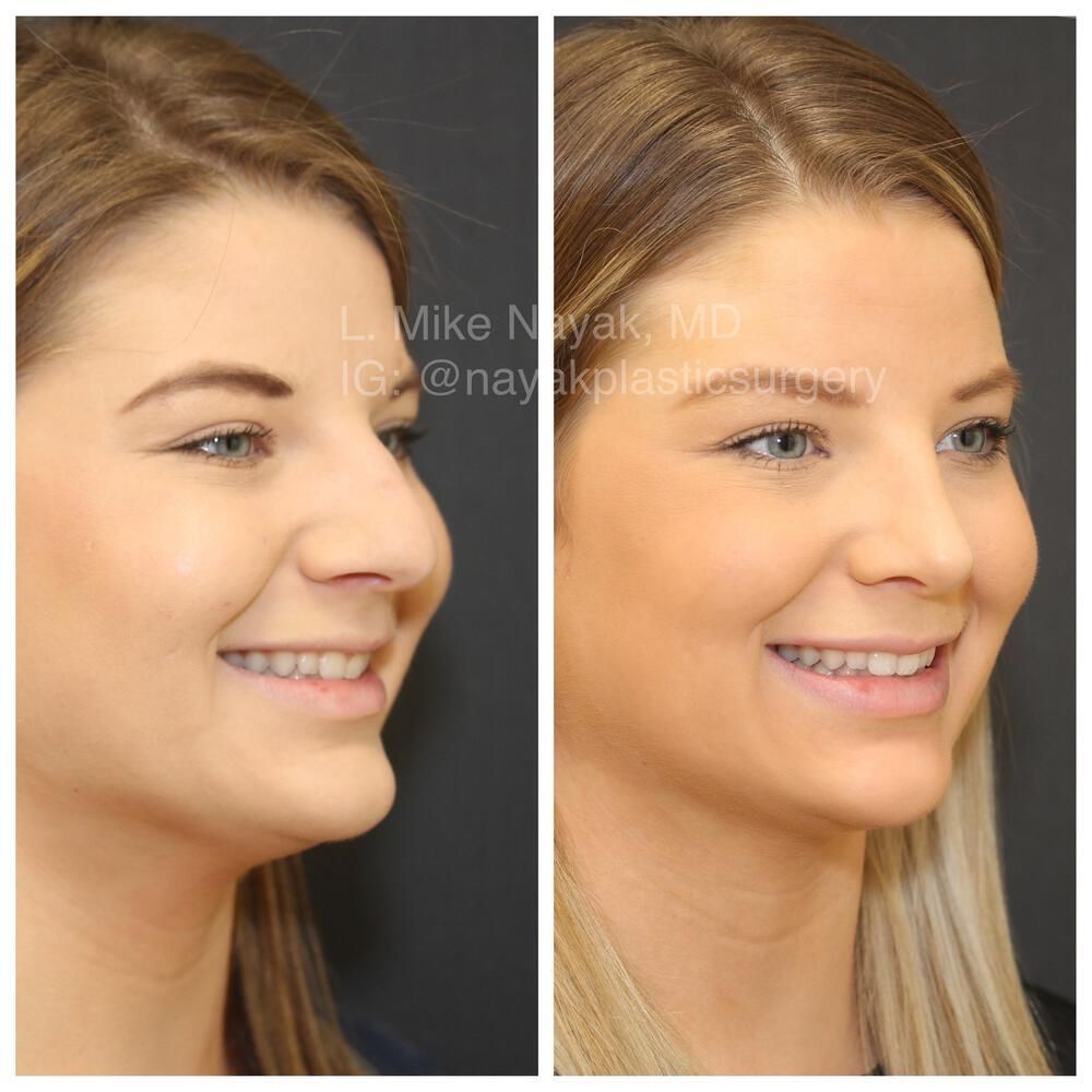 Rhinoplasty Before & After