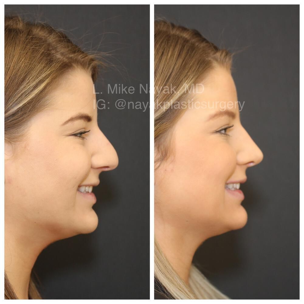 Rhinoplasty Before & After