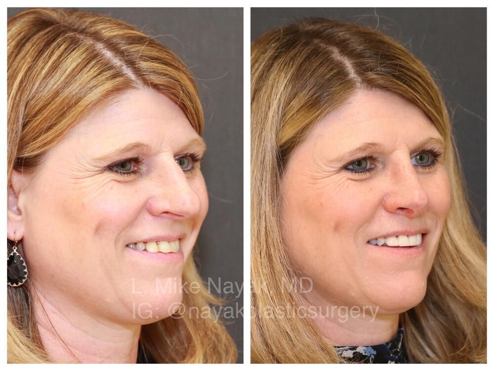 Rhinoplasty Before & After