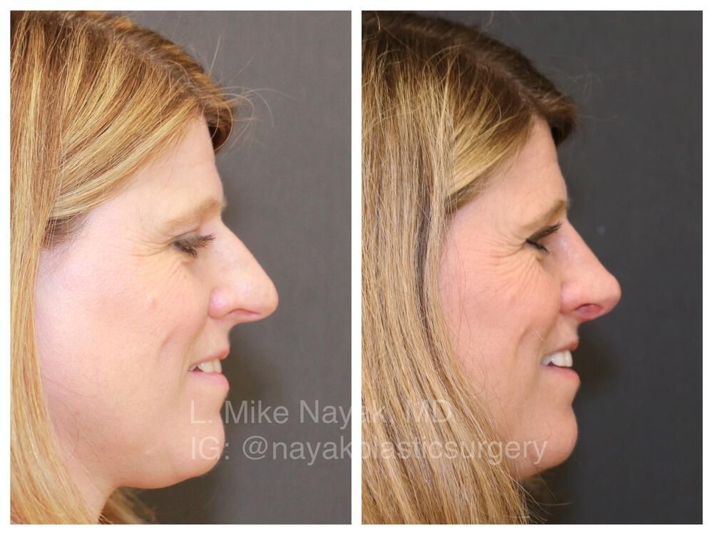 Rhinoplasty Before & After