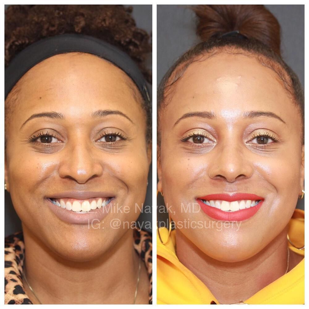 Rhinoplasty Before & After