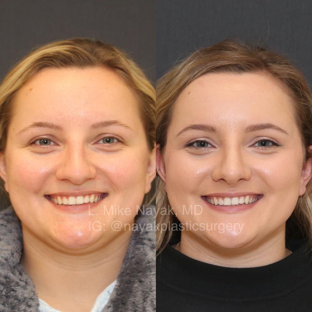 Rhinoplasty Before & After