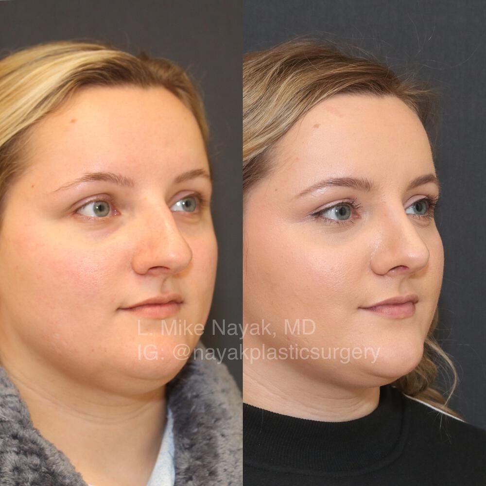 Rhinoplasty Before & After