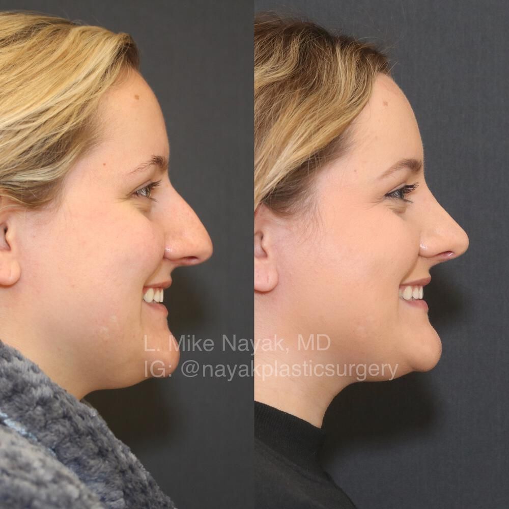 Rhinoplasty Before & After