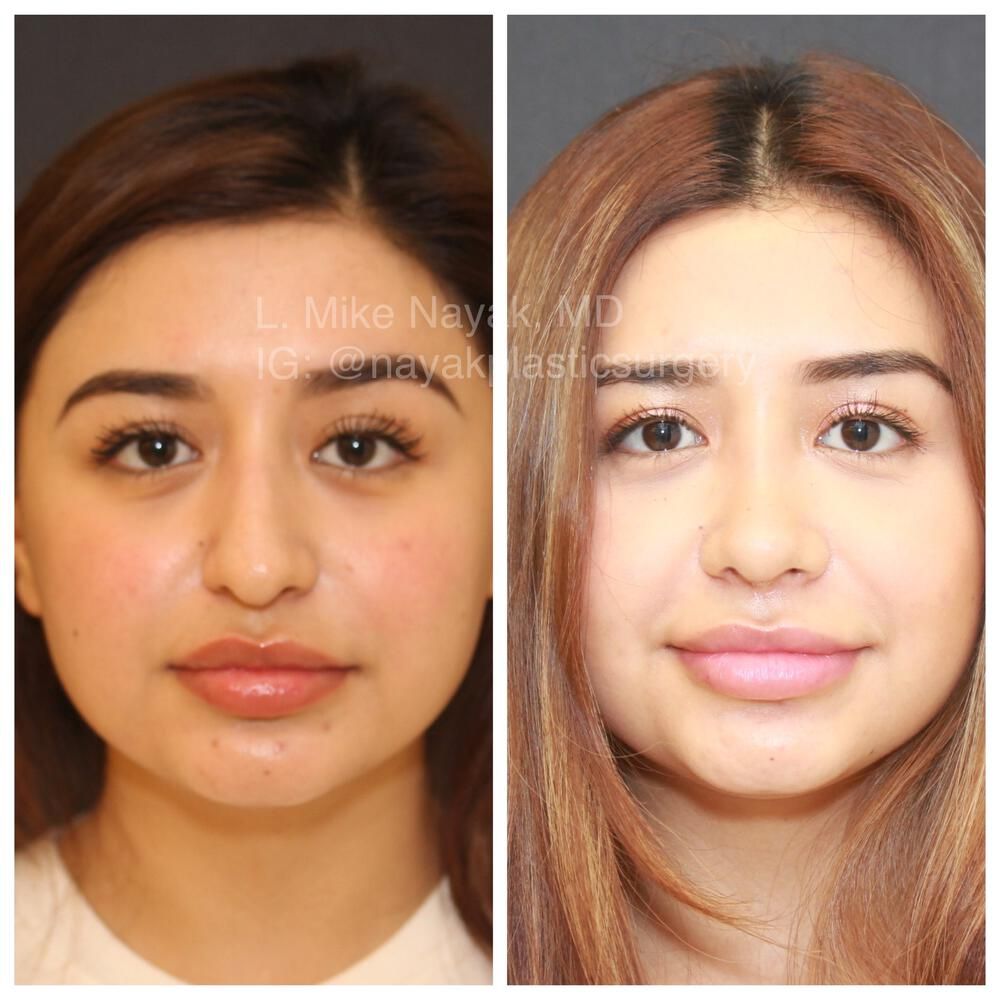 Rhinoplasty Before & After