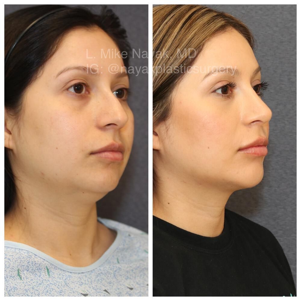 Rhinoplasty Before & After