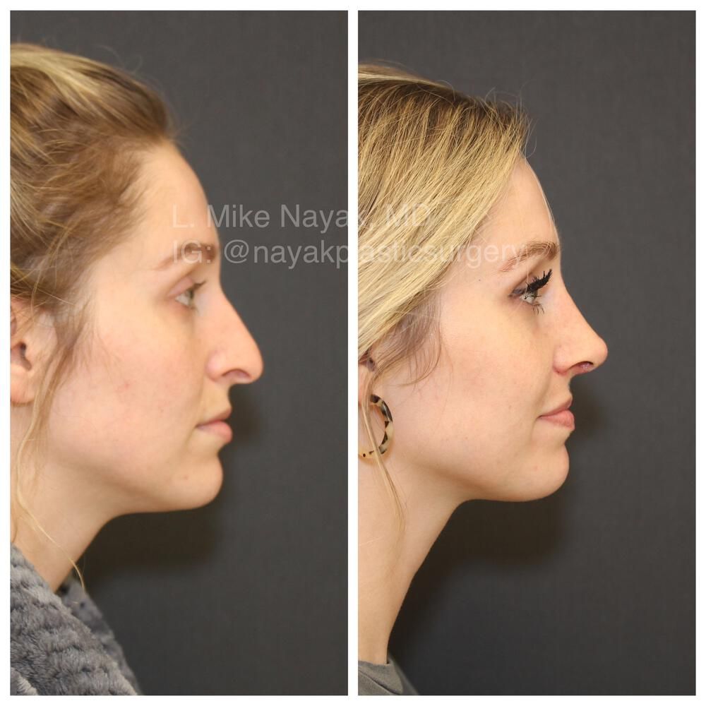 Rhinoplasty Before & After
