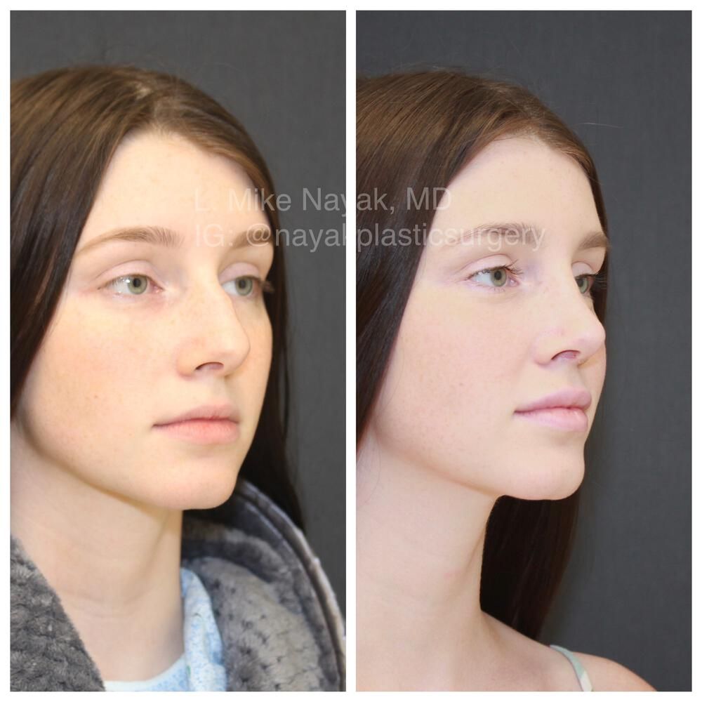 Rhinoplasty Before & After