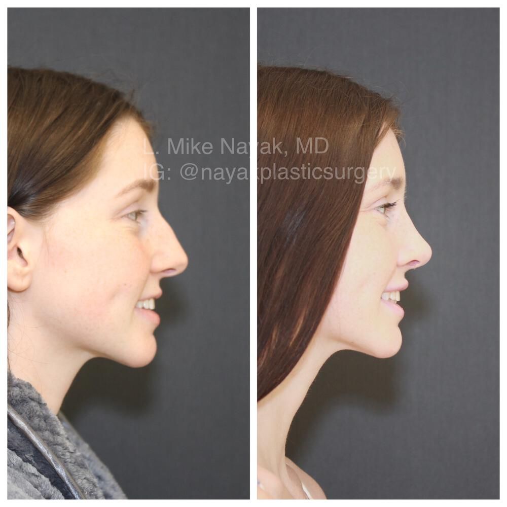 Rhinoplasty Before & After