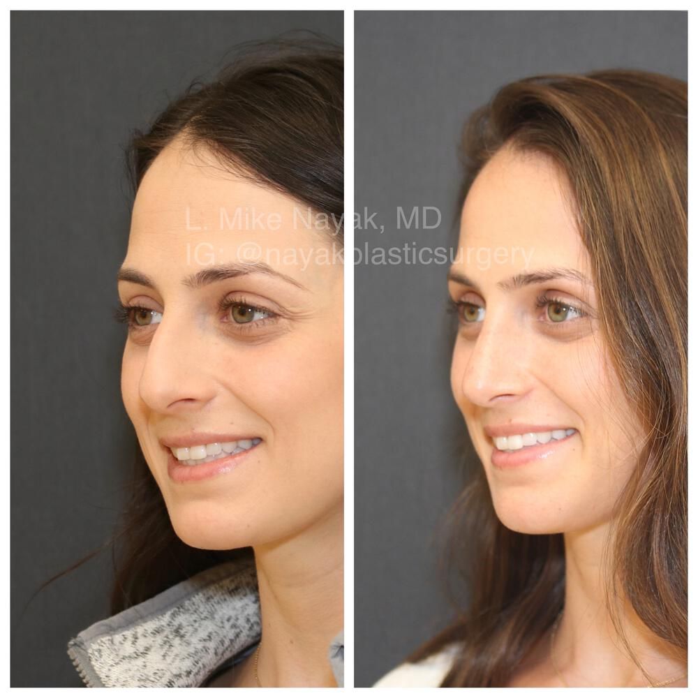 Rhinoplasty Before & After