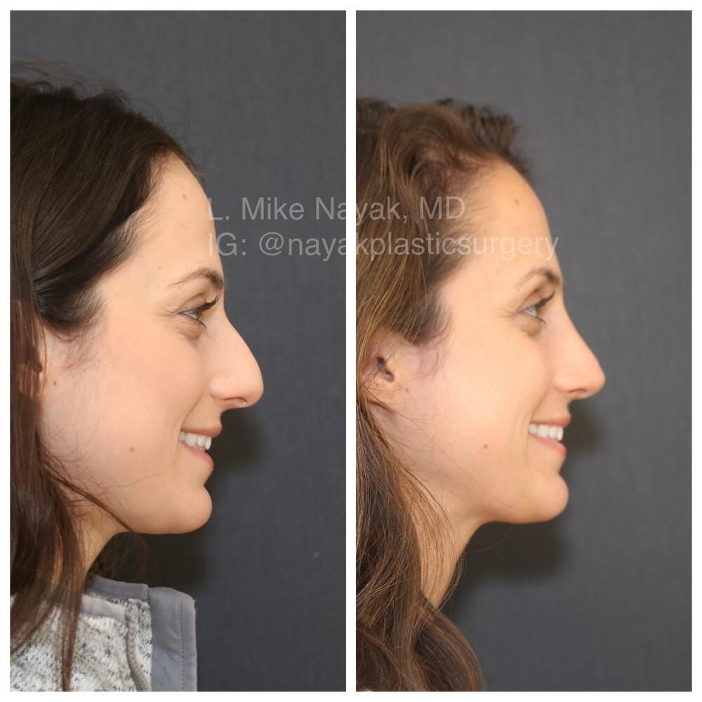 Rhinoplasty Before & After