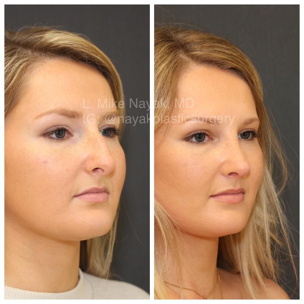Rhinoplasty Before & After