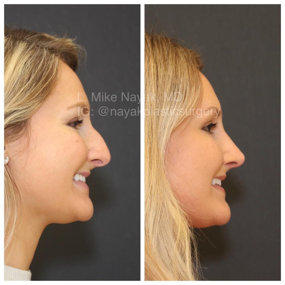 Rhinoplasty Before & After