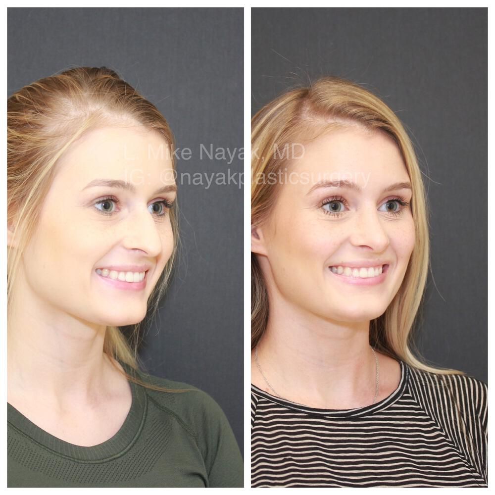Rhinoplasty Before & After