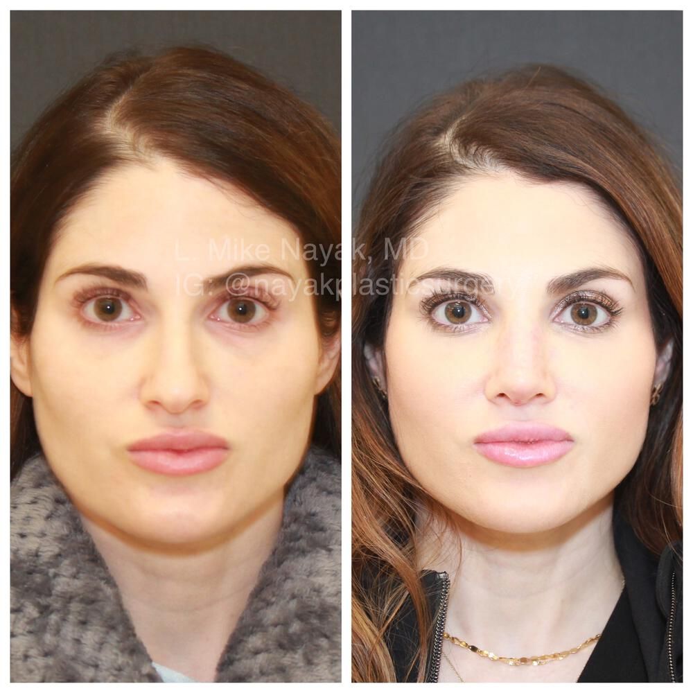 Rhinoplasty Before & After