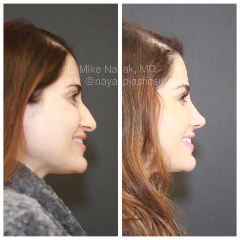 Rhinoplasty Before & After