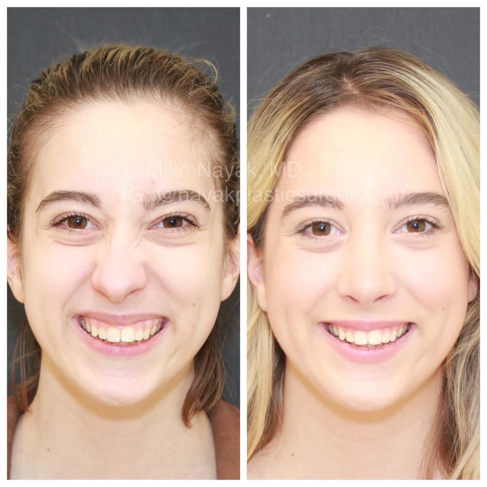 Rhinoplasty Before & After